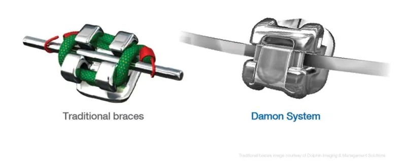 A side-by-side comparison image showing a Traditional Braces bracket with colored bands next to a sleek Damon System self-ligating bracket.